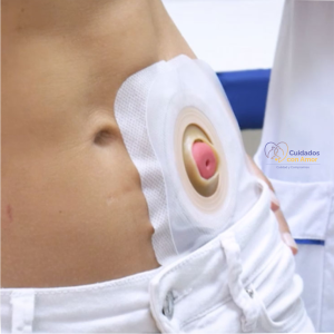 Lee más sobre el artículo Manejo de colostomias